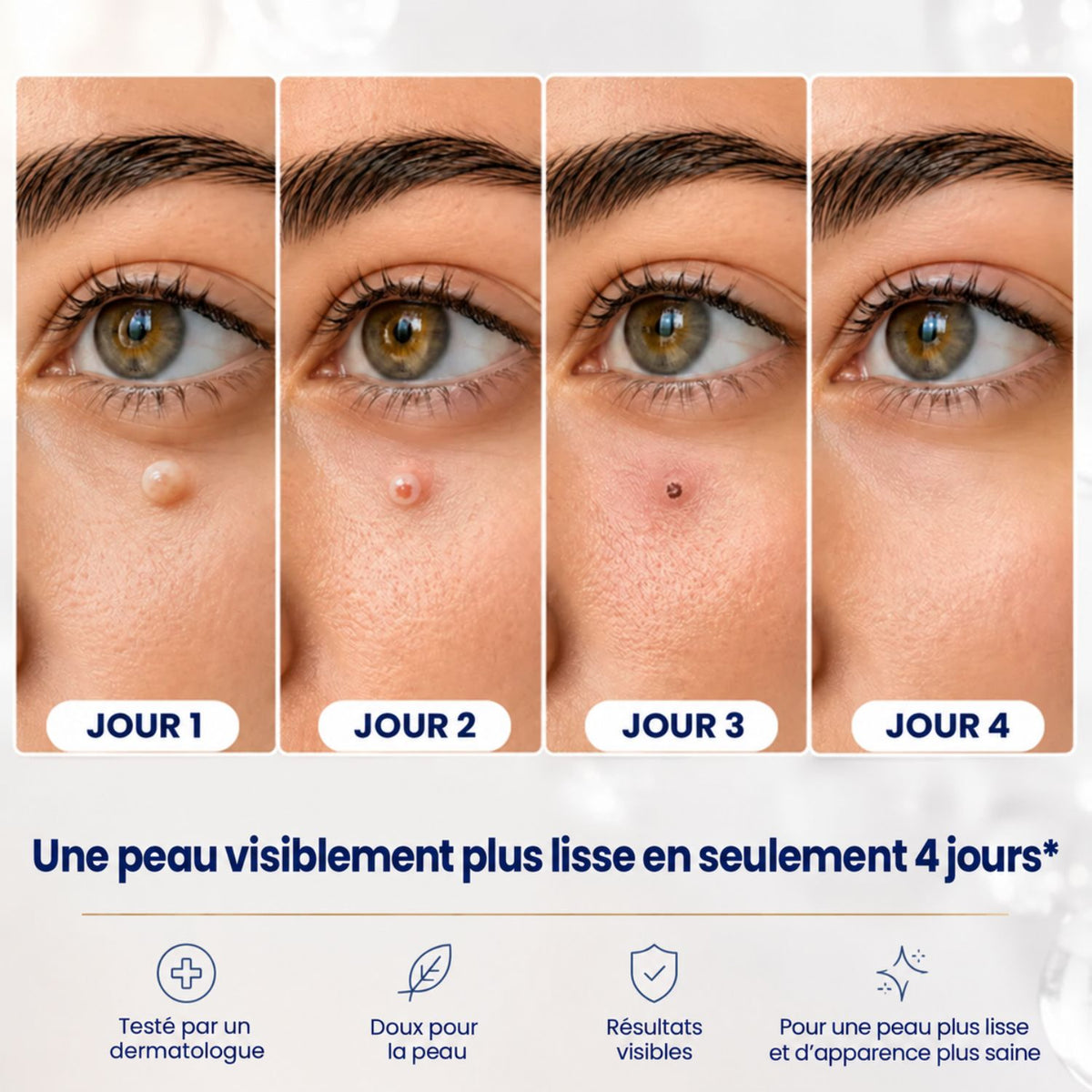 AcroSoft™ | Une peau lisse en seulement 4 jours