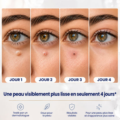 AcroSoft™ | Une peau lisse en seulement 4 jours