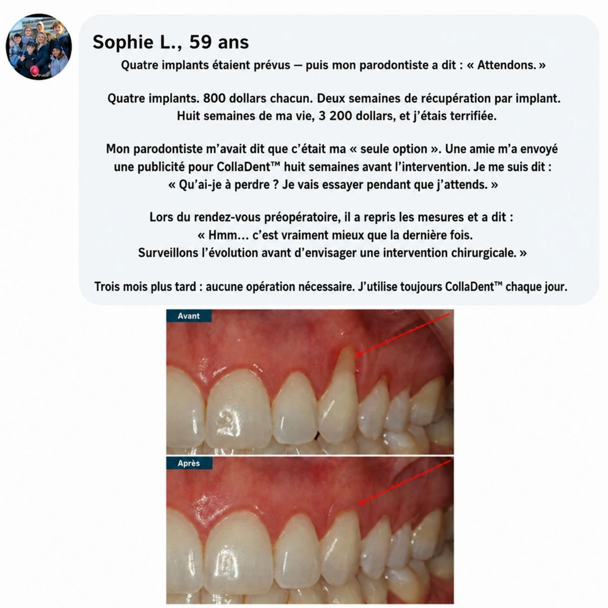 CollaDent™ | Renforcez vos gencives de l’intérieur et préservez votre sourire naturel