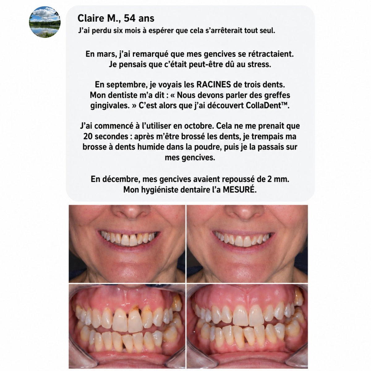 CollaDent™ | Renforcez vos gencives de l’intérieur et préservez votre sourire naturel